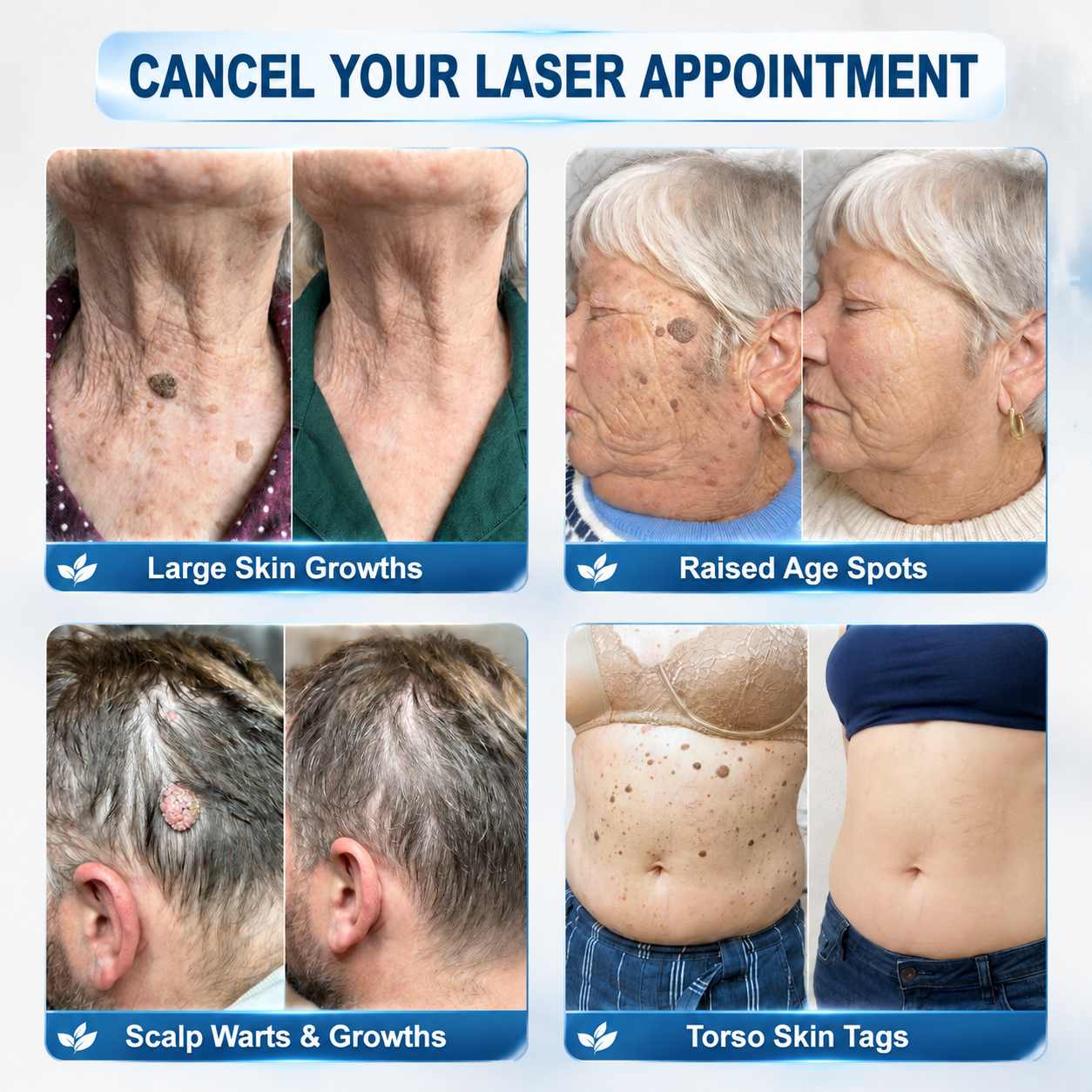 𝐇𝐈𝐒𝐊𝐈𝐍®👩‍⚕️😍𝟕-𝐃𝒂𝘆 𝐒𝗸𝐢𝐧 𝐓𝒂𝗴 & 𝐒𝐩𝙤𝐭 𝐄𝐫𝒂𝐬𝙚𝐫 Painless & Scar-Free Advanced Imperfection Removal Rollerball Pen