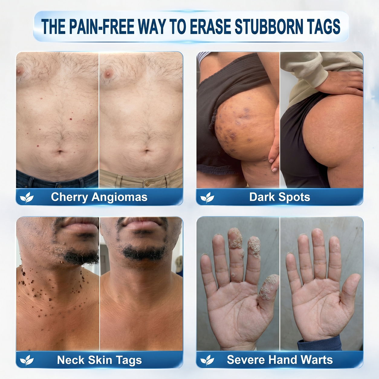 𝐇𝐈𝐒𝐊𝐈𝐍®👩‍⚕️😍𝟕-𝐃𝒂𝘆 𝐒𝗸𝐢𝐧 𝐓𝒂𝗴 & 𝐒𝐩𝙤𝐭 𝐄𝐫𝒂𝐬𝙚𝐫 Painless & Scar-Free Advanced Imperfection Removal Rollerball Pen