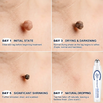 𝐇𝐈𝐒𝐊𝐈𝐍®👩‍⚕️😍𝟕-𝐃𝒂𝘆 𝐒𝗸𝐢𝐧 𝐓𝒂𝗴 & 𝐒𝐩𝙤𝐭 𝐄𝐫𝒂𝐬𝙚𝐫 Painless & Scar-Free Advanced Imperfection Removal Rollerball Pen